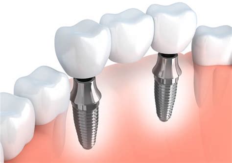 bridge implant in ashford|Dental Implants Ashford.
